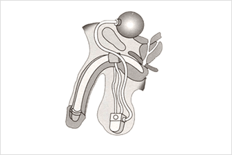 prosthesis